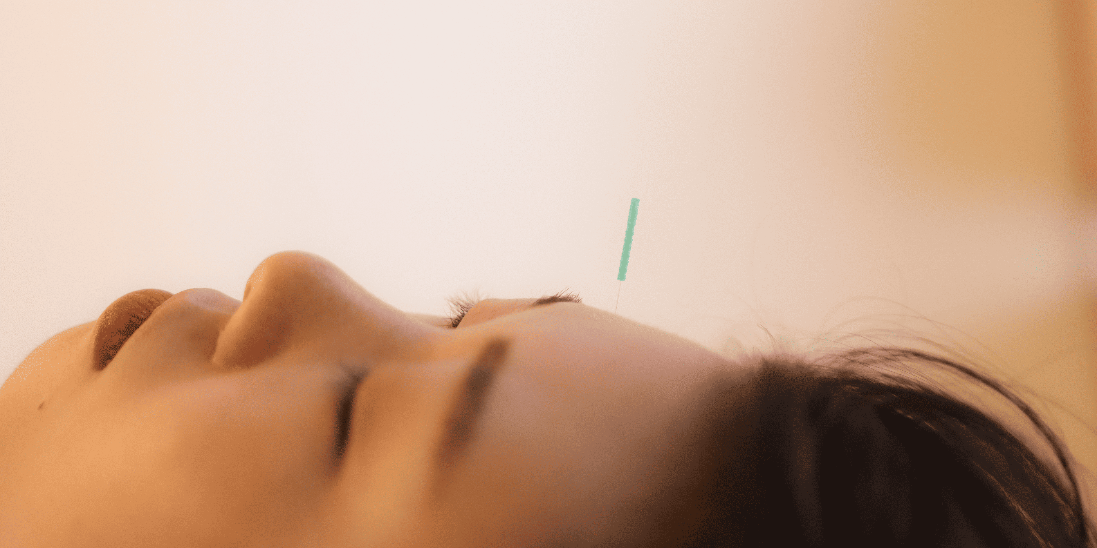 Medical Acupuncture